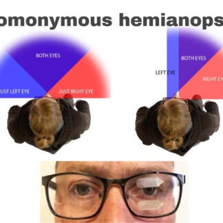 hemianopsia chart